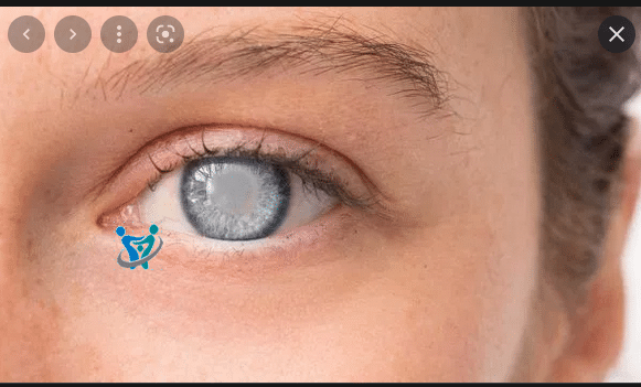 الماء الأبيض في العين أعراضه وعلاجه 3 الماء الأبيض في العين أعراضه وعلاجه